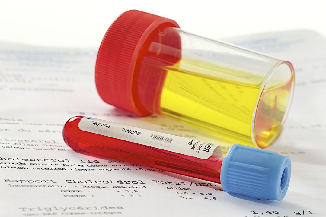 Kraujo ir šlapimo tyrimas padės nustatyti prostatito buvimą.