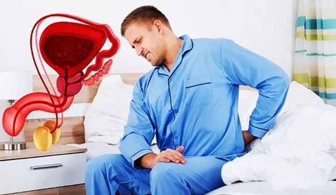 apatinės nugaros dalies skausmas dėl prostatito