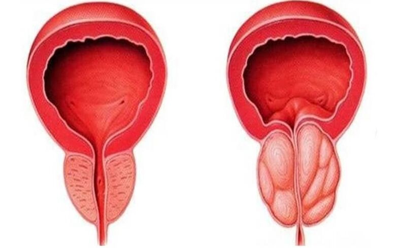 sveika ir uždegusi prostata su prostatitu