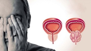 vyrų prostatito priežastys