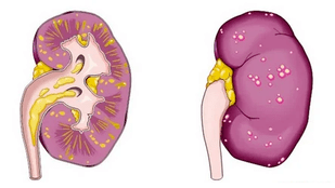 kas sukelia ūminį prostatitą
