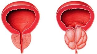 Prostatitas