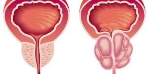 prostatitas