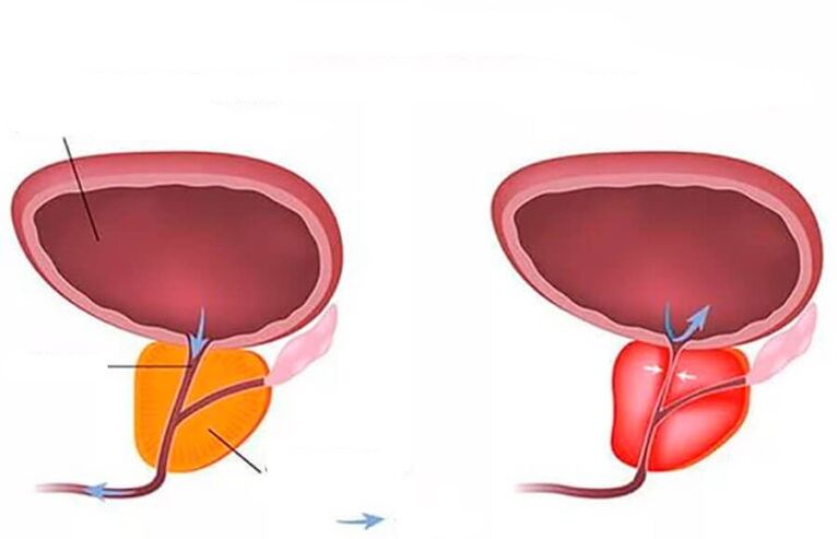 normali ir uždegusi prostata