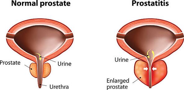 normali ir uždegusi prostata