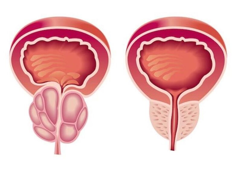 Prostatitas