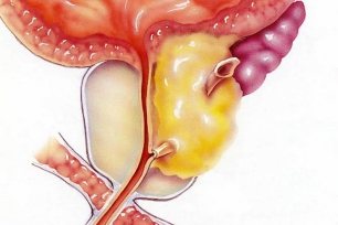 prostatitas